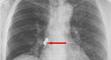 Afyonkarahisar'da bir kişinin soluk borusuna kaçan 2 implant çıkarıldı