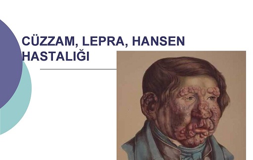Lepra ( Cüzzam, Hansen Hastalığı ) Haftası